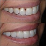 veneers-before-and-after-right-21